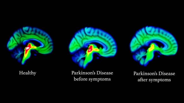 Ketahui Gejala Non Motorik dan Motorik Serangan Awal Parkinson serta Cara Penanganannya