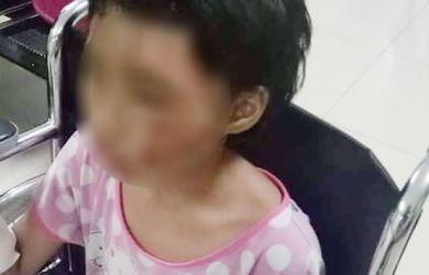 Kisah Pilu Anak Yatim Disiram Air Panas, Wajah dan Tangan Melepuh
