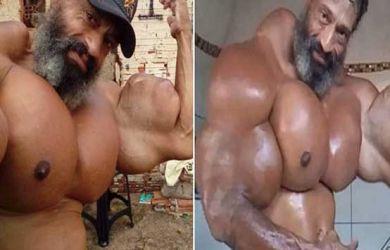 Demi Badan Kekar dan Berotot, Pria Ini Rela Suntikan Banyak Minyak ke Tubuhnya