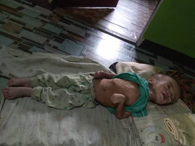 A. Sukur, Balita 15 Bulan Derita Gizi Buruk, Butuh Bantuan Biaya Pengobatan Segera