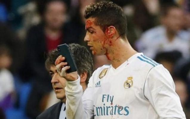 Aksi Heroik Ronaldo Berujung Wajah Bersimbah Darah