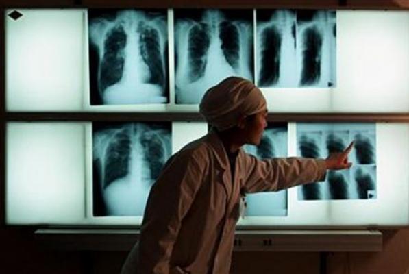 Fakta Seputar Penyakit Tuberkulosis