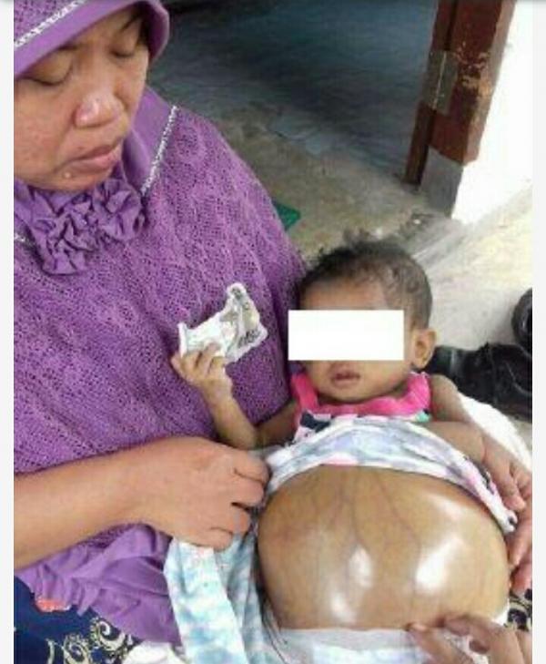 Atas Perintah Bupati, Balita yang Mengalami Perut Membesar Akhirnya Dirawat di RSUD Indrasari Inhu