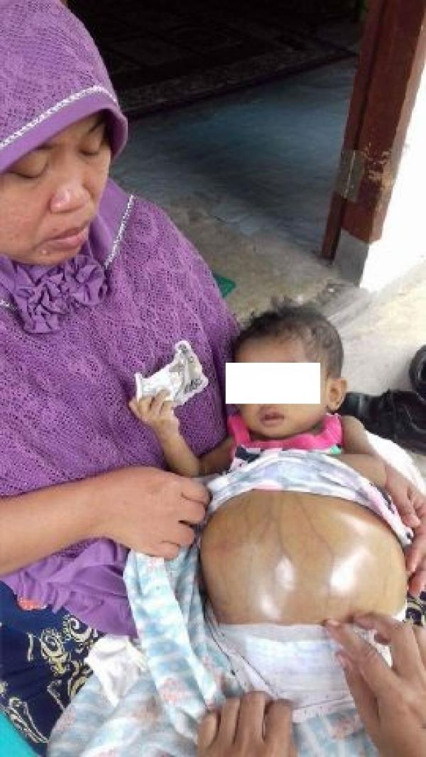 Butuh Bantuan Pemerintah, Perut Anak Usia 7 Bulan di Inhu Membesar Karena Mengidap Penyakit Gagal Hati