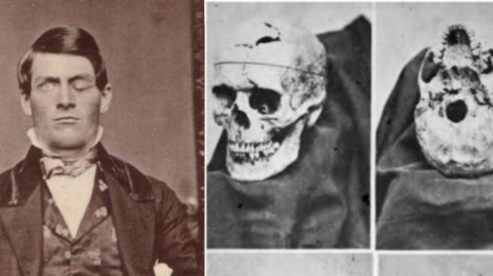 Pria Selamat Meski Tengkorak Kepala Tertembus Batang Besi, Jadi Kasus Medis Paling Langka di Sejarah