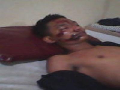 Dimas  Luka Parah Setelah Tabrak Tumpukan Pasir 