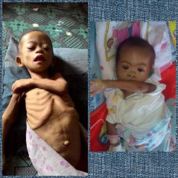 Balita Penderita Gizi Buruk Asal Kempas, Inhil Meninggal