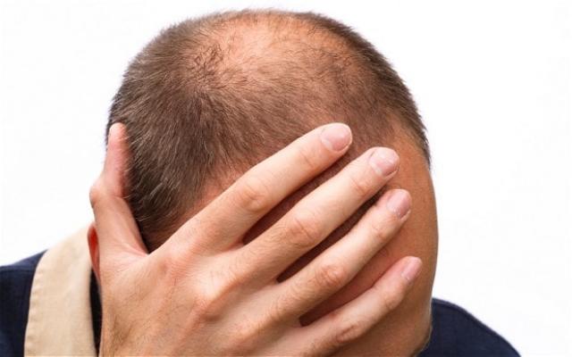 Risiko serangan jantung pun bisa dilihat dari pola kebotakan rambut, berikut penjelasannya