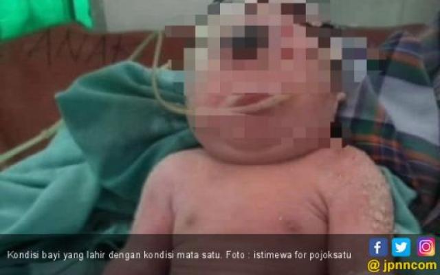 Bayi Terlahir dengan Hanya Mata Satu di Kening Itu Meninggal