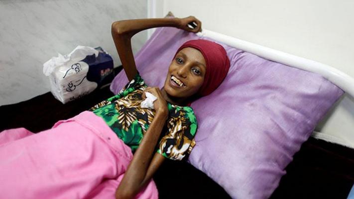 Yaman Terancam Kelaparan Meluas karena Blokade Arab Saudi
