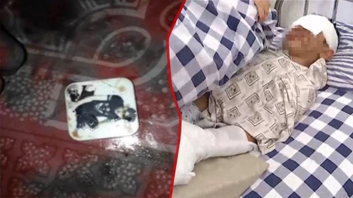 Alat Pemutar Musik KW Buatan China Ini Tiba-tiba Meledak, Wajah Bocah Ini Terluka Parah