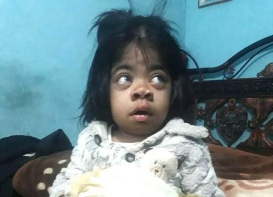 Kasihan, Gadis Cilik Ini Derita Hernia Tali Pusar yang Menggantung di Perut. Beratnya Mencapai 1 Kg