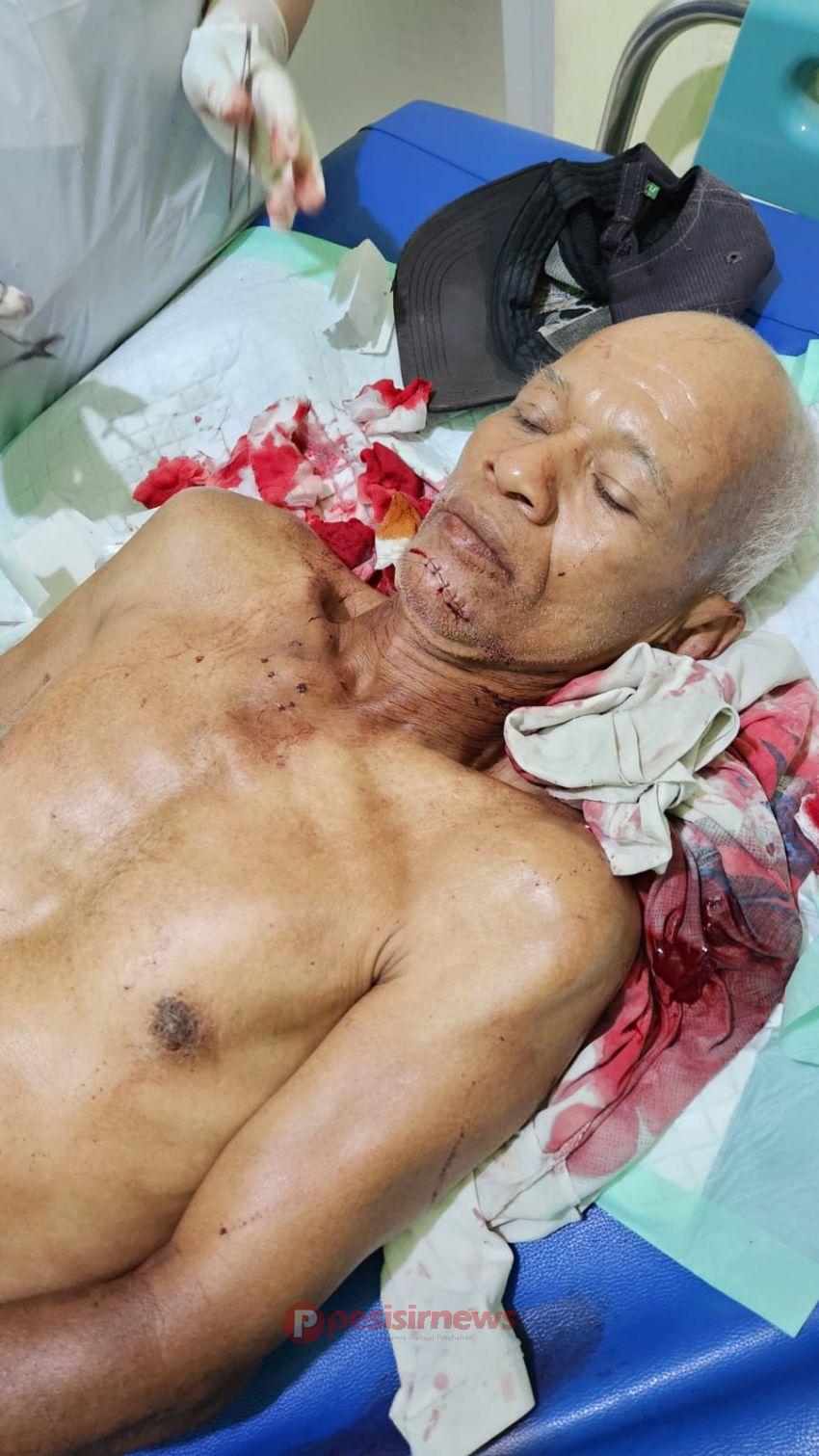 Kayuh Becak Terhenti, Suratman alias Rano Kini Terbaring Menahan Luka 40 Jahitan